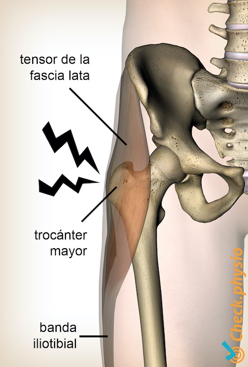anatomía del síndrome de dolor del trocánter mayor de la cadera tensor fascia lata banda iliotibial