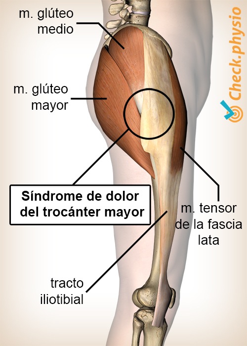 anatomía del síndrome de dolor del trocánter mayor de la cadera
