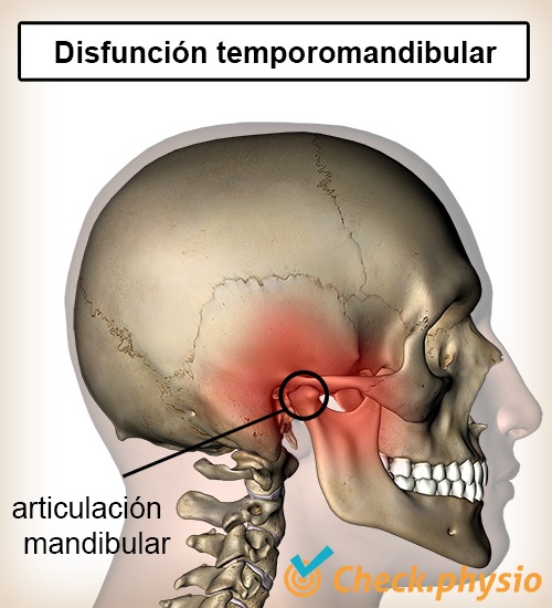 cabeza disfunción discal de la mandíbula articulación temporomandibular
