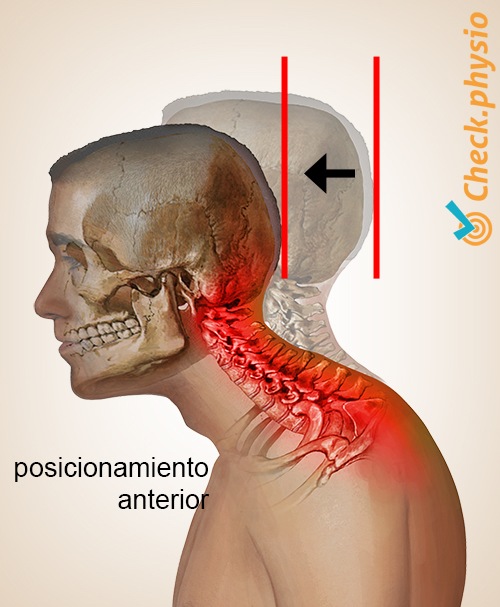 cabeza síndrome de postura cervical del cuello anteroposición de la cabeza adelantada