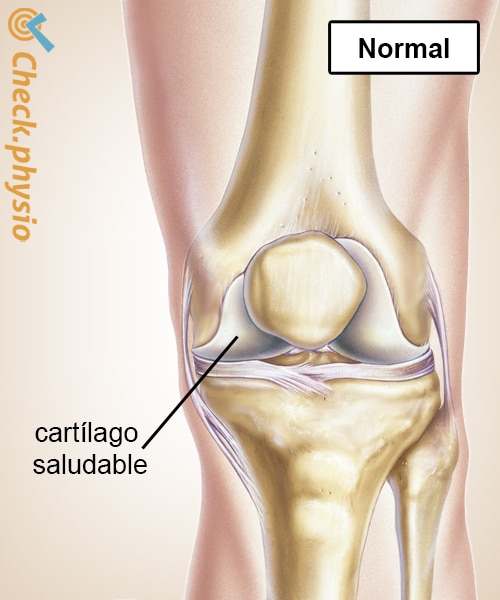 artrosis de rodilla cartílago sano