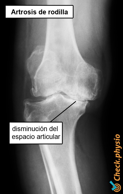artrosis de rodilla radiografía