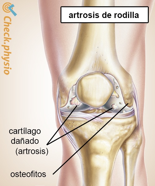 artrosis de rodilla cartílago deteriorado