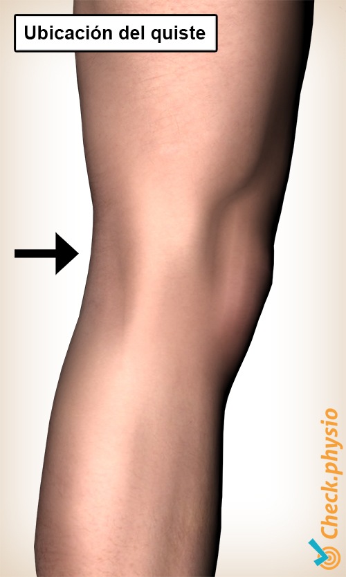 rodilla ubicación del quiste de baker fosa de la parte posterior de la rodilla