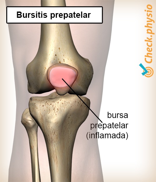 rodilla bursitis prepatelar bursa inflamada rótula de rodilla rótula