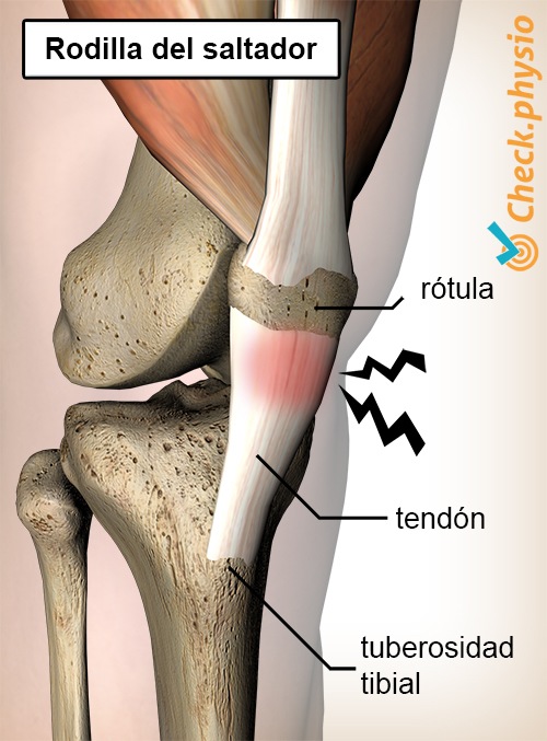 rodilla dolor de rodilla de saltador tendinitis del tendón rotuliano
