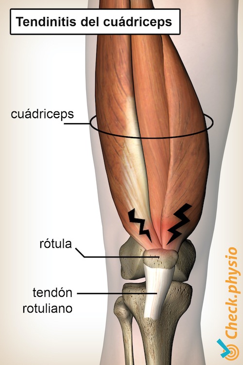 rodilla tendinitis del cuádriceps anatomía