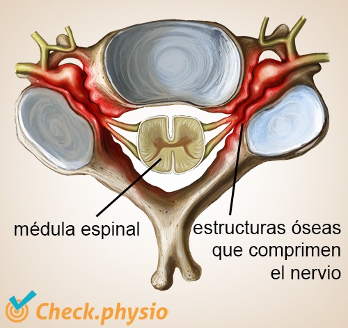 cuello radiculopatía cervical estenosis hernia dura