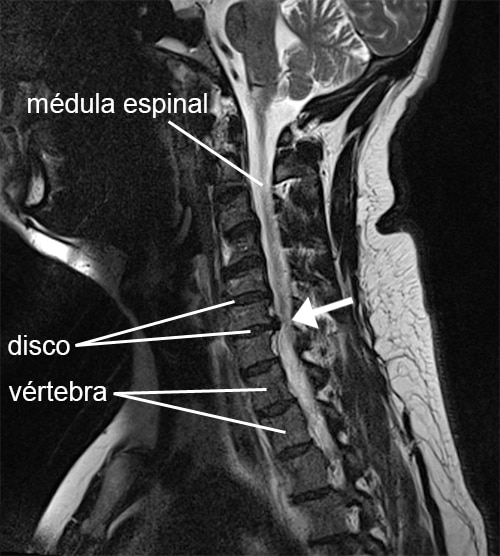 cuello radiculopatía cervical hernia blanda