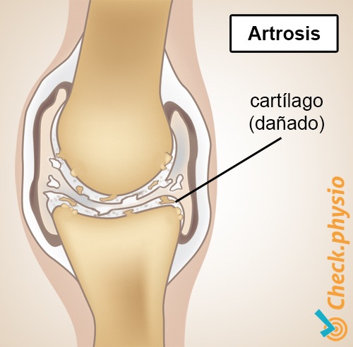 artrosis anatomía deteriorada