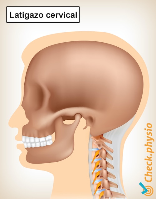 dolor de latigazo cervical