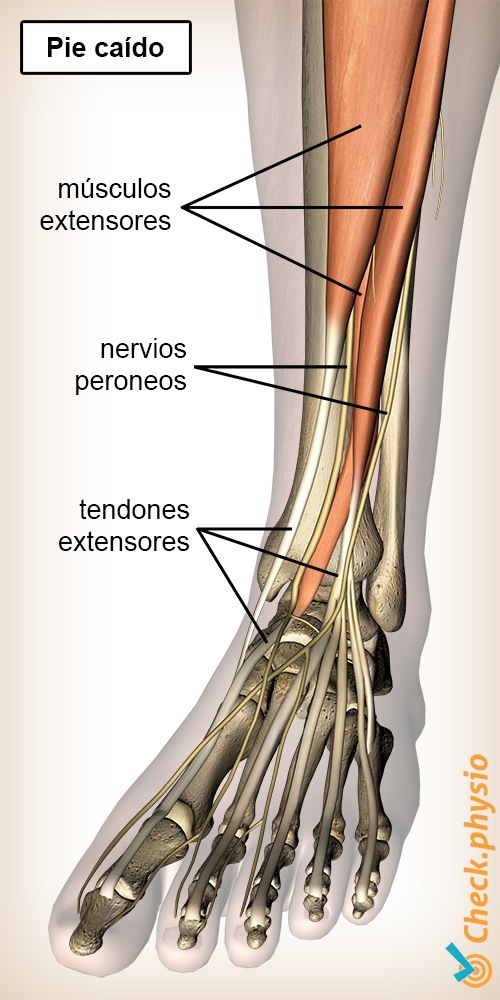 pantorrilla pie caído nervios peroneos extensores del pie músculos tendones