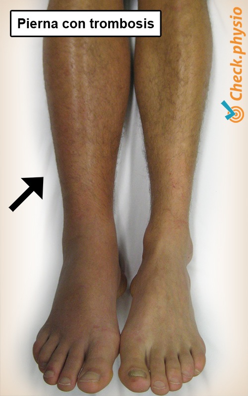 parte inferior de la pierna pierna trombosada trombosis hinchazón por trombosis