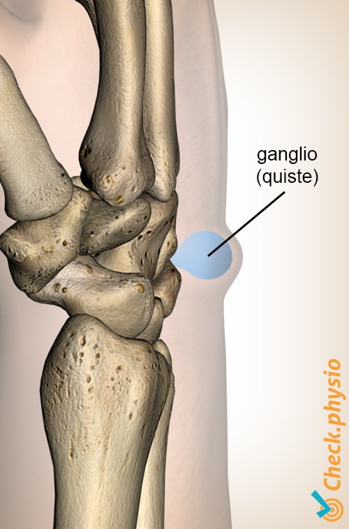 muñeca ganglión quiste anatomía