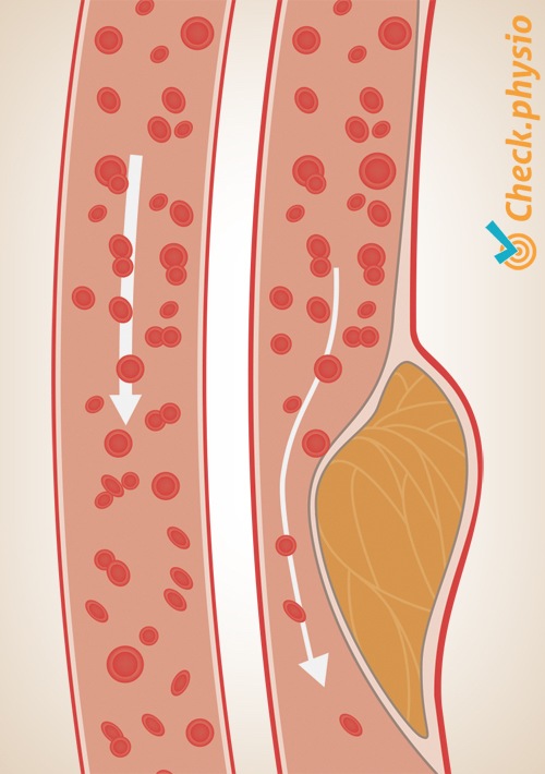 arteriosclerosis arteria