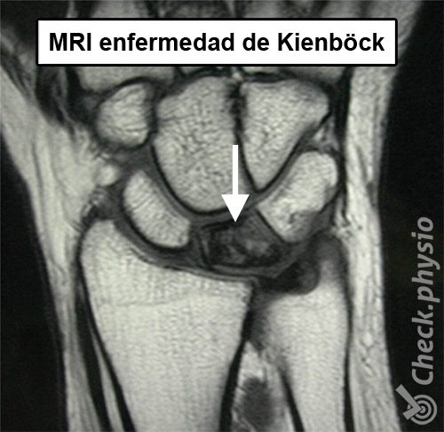 muñeca enfermedad de Kienbock resonancia magnética hueso carpiano semilunar