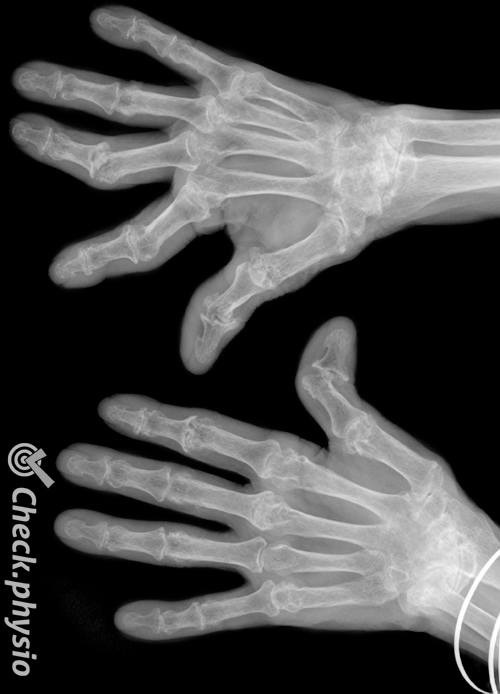 artritis reumatoide radiografía