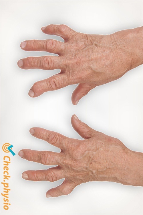 artritis reumatoide dedos