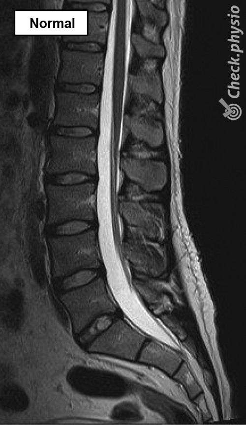 espalda columna lumbar resonancia magnética normal