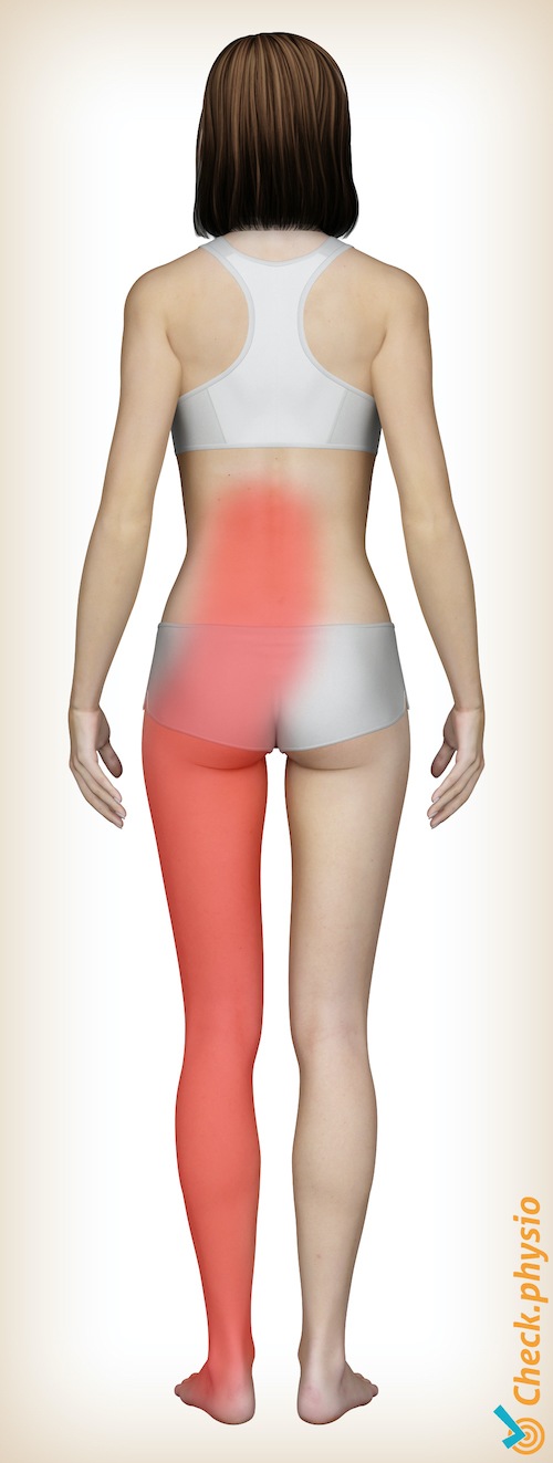 espalda síndrome radicular lumbosacro ubicación del dolor de hernia