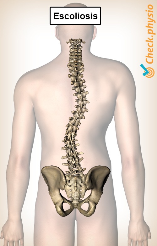 espalda escoliosis curvatura de la columna columna vertebral