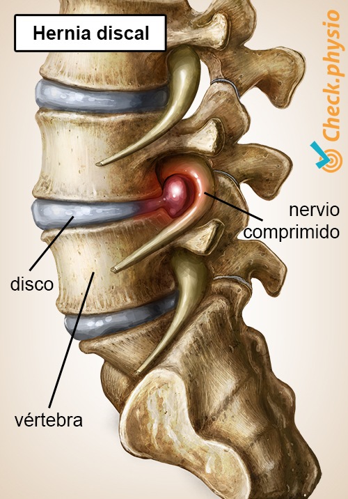 espalda lumbalgia específica hernia discal