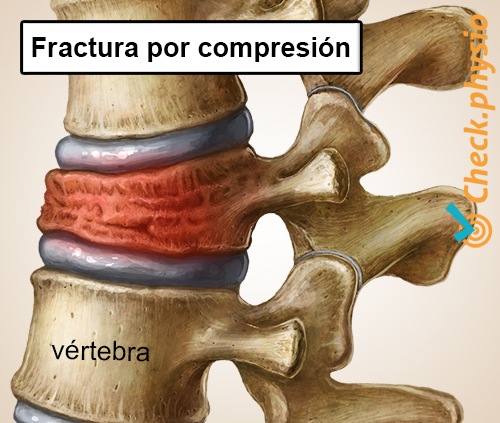 espalda lumbalgia específica vértebra colapsada