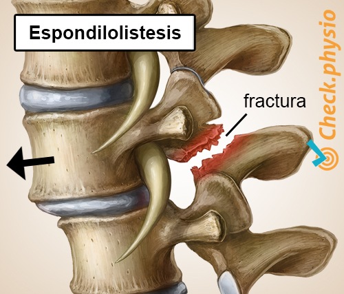 espalda lumbalgia específica espondilolistesis vértebra desplazada