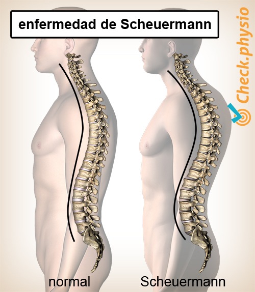 espalda enfermedad de Scheuermann postura de columna vertebral cifosis convexa