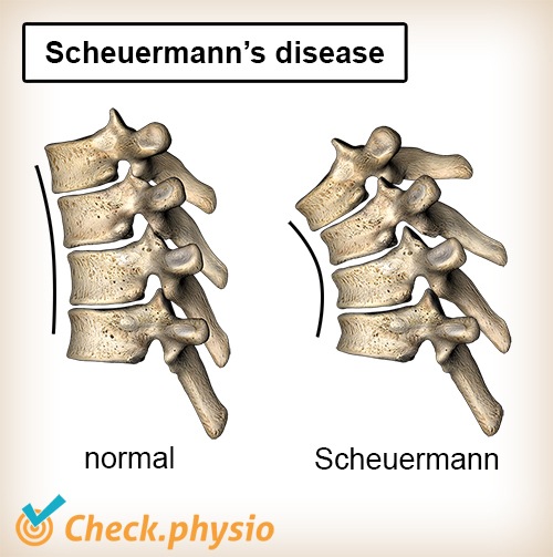 espalda enfermedad de Scheuermann postura de columna columna vertebral normal cifosis convexa anatomía en forma de cuña
