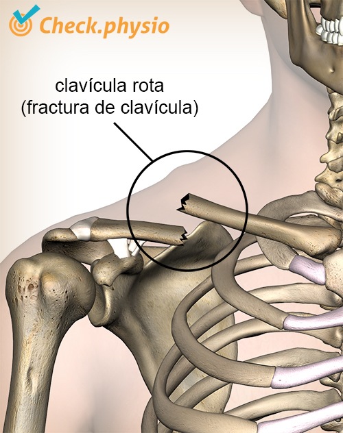 hombro fractura de clavícula clavícula rota fractura