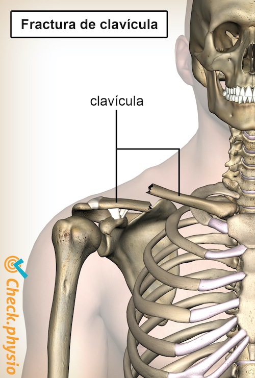 hombro fractura de clavícula clavícula rota
