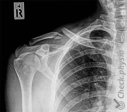 hombro fractura de clavícula clavícula rota radiografía
