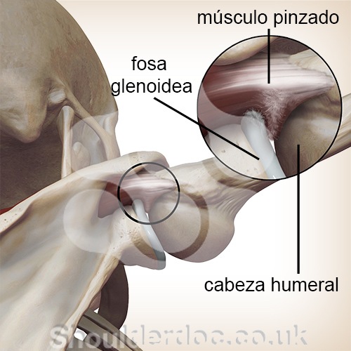 hombro pinzamiento interno cabeza humeral cavidad fosa glenoidea zoom