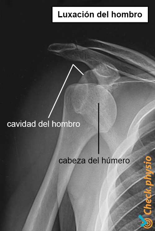 radiografía hombro luxación dislocación
