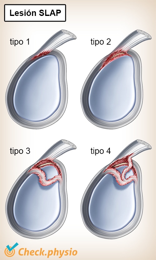 hombro tipos de lesiones slap 1 2 3 4