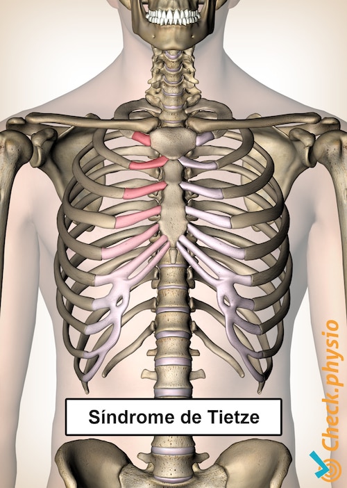 síndrome de Tietze dolor de costillas pecho esternón