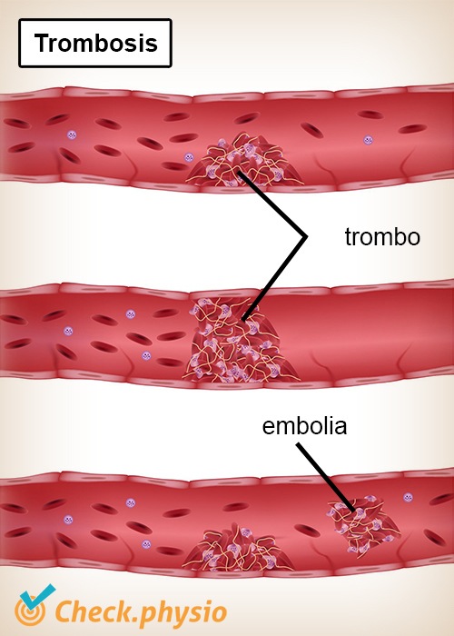 trombosis trombo embolia arteria vena vaso sanguíneo
