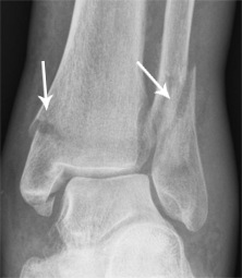 pie fractura de tobillo radiografía