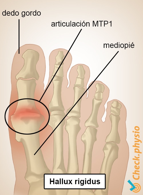 pie hallux rigidus dedo gordo MTF 1 articulación