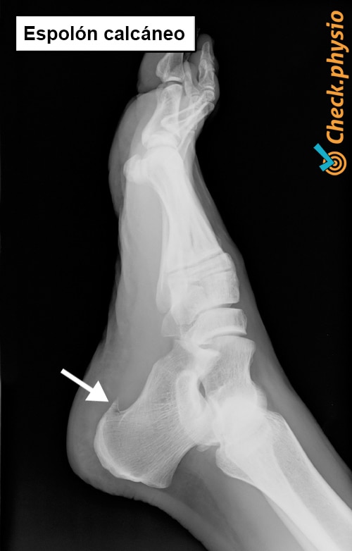 pie radiografía del espolón calcáneo