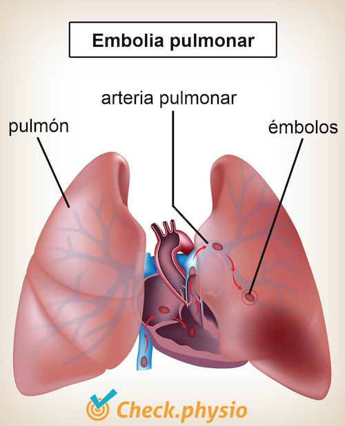 pecho pulmones embolia pulmonar corazón arteria