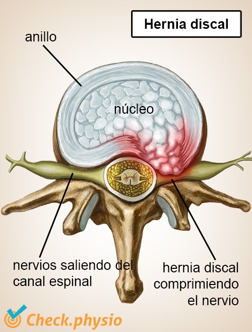 columna columna vertebral vértebra disco intervertebral hernia nervios 