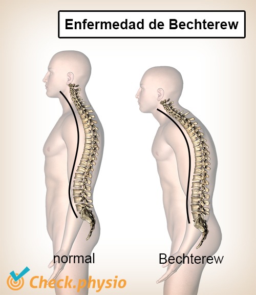 enfermedad de Bechterew cifosis espalda convexa