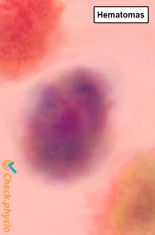 contusión hematoma rojo amarillo