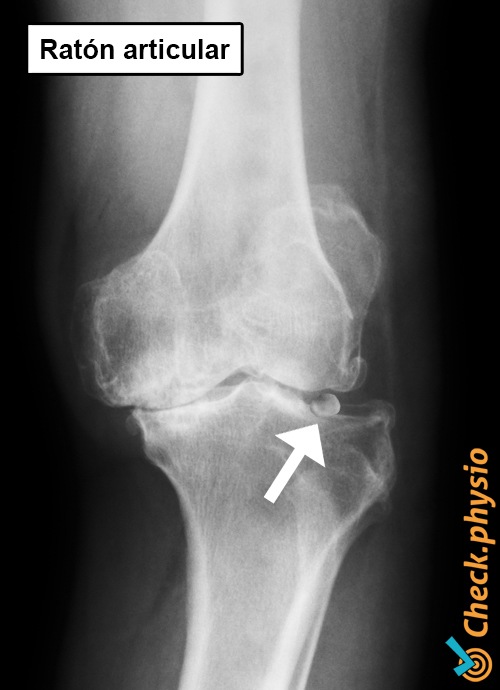 radiografía de cuerpo libre intraarticular de rodilla