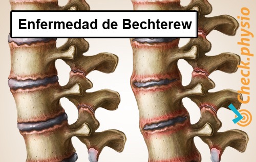 espalda lumbalgia específica enfermedad de bechterews espondilitis anquilosante