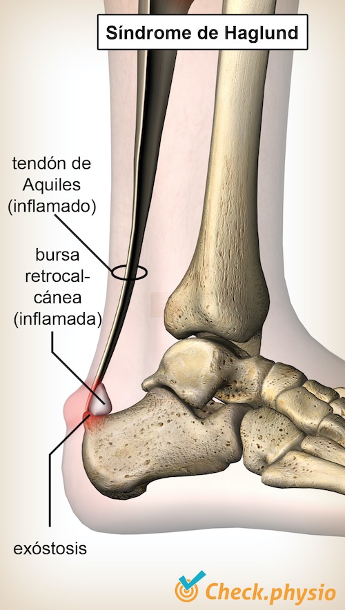 tobillo síndrome de haglund tendón de aquiles bursa retrocalcánea hueso del talón calcáneo