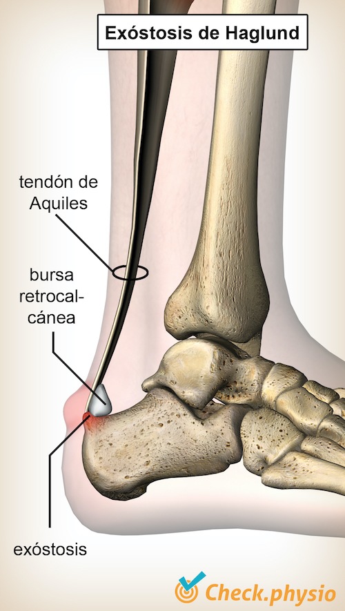 tobillo exostosis de Haglund deformidad tendón de Aquiles bolsa retrocalcánea hueso del talón calcáneo