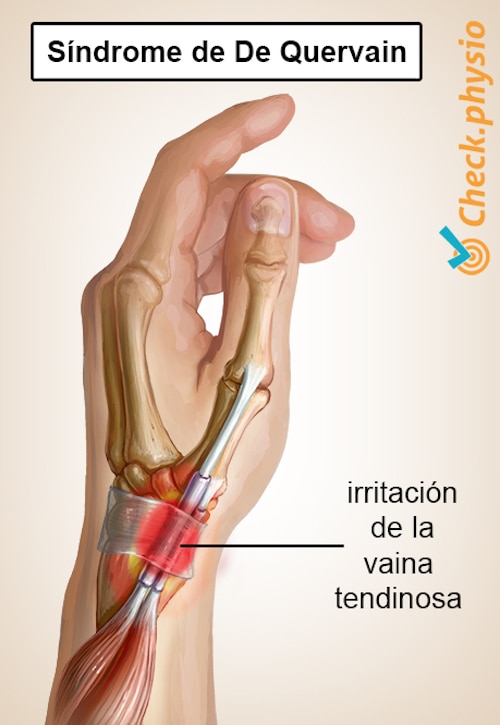 brazo enfermedad de De Quervain